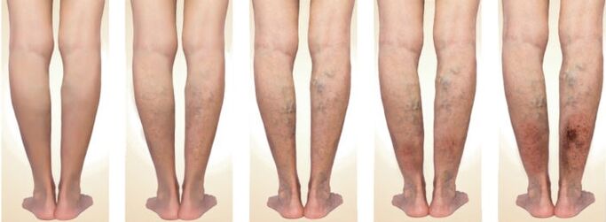 stages of development of varicose veins