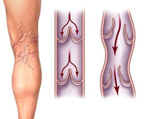 Normal functioning of the valves in a healthy vein and pathology of the valves in a varicose vein