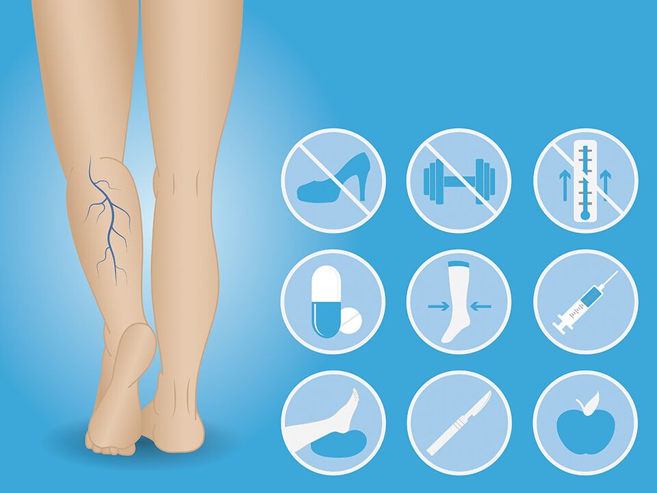 Lower limb varicose veins