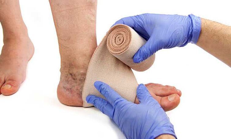 The treatment of varicose veins of the legs is supplemented by the use of compression stockings