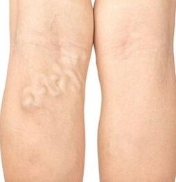 Varicose symptoms