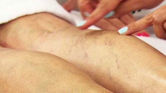 Varices of the lower limbs