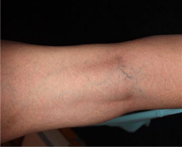 Varicose symptoms