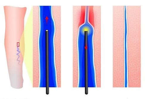 Laser coagulation