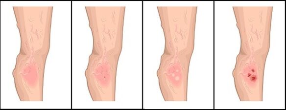 The degree of varicose veins