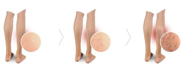 varicose veins