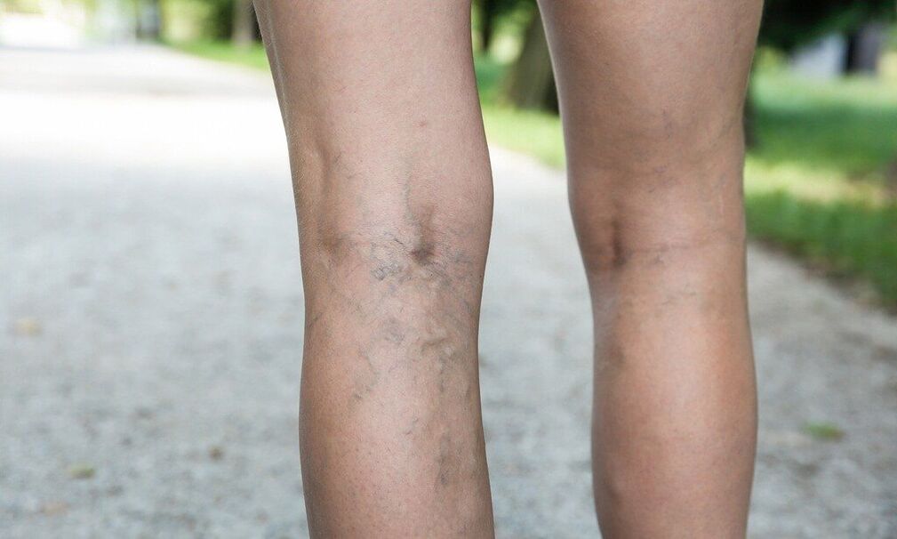 Varicose veins