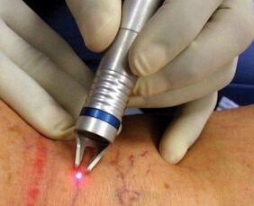 How laser treatment of varicose veins is carried out