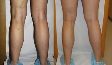 Laser treatment of photo varicose veins before and after