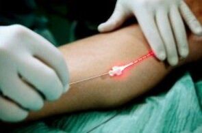 Laser treatment varicose veins on the legs