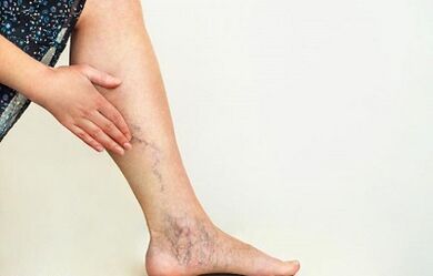 how to treat varicose veins of the lower limbs