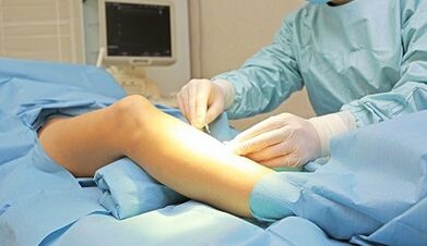 For what symptoms is varicose vein surgery prescribed