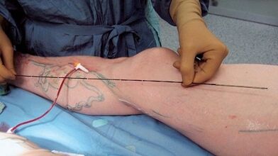 How is varicose vein surgery carried out