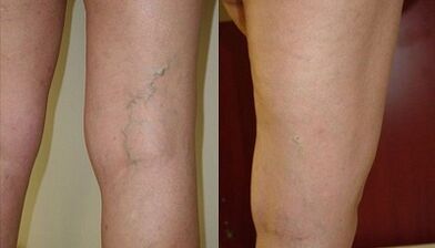 microphlebectomy for varicose veins