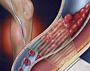 varicose veins of the deep veins of the lower limbs