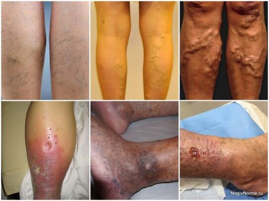 The degree of damage to varicose veins
