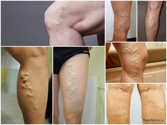 What is varicose veins