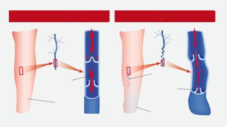 What the varicose veins look like