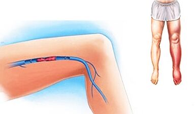 Possible complications of varicose veins